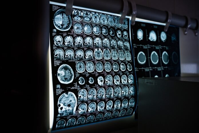 radiomica, mesotelioma. terapie efficaci grazie all'AI